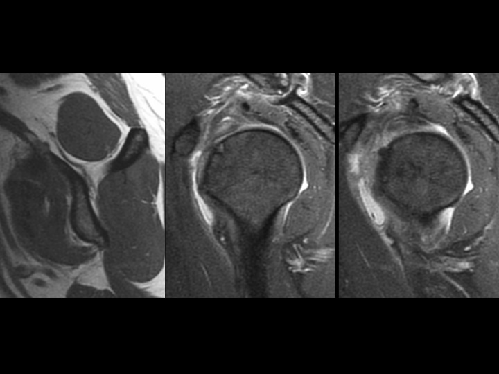Figure 2 for case subscapularis tendon ( RID1951 )